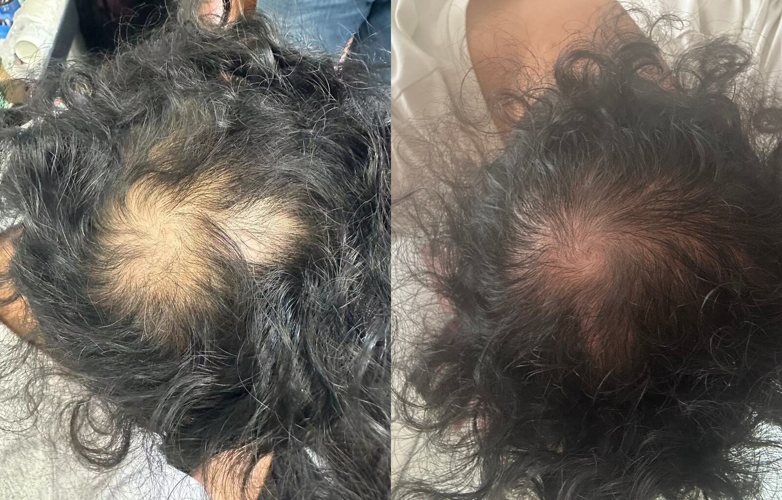 Before and after hair appearance for Founder's own hair