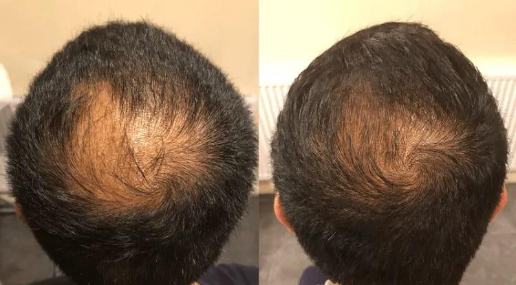 Before and after hair appearance for Robert, 48