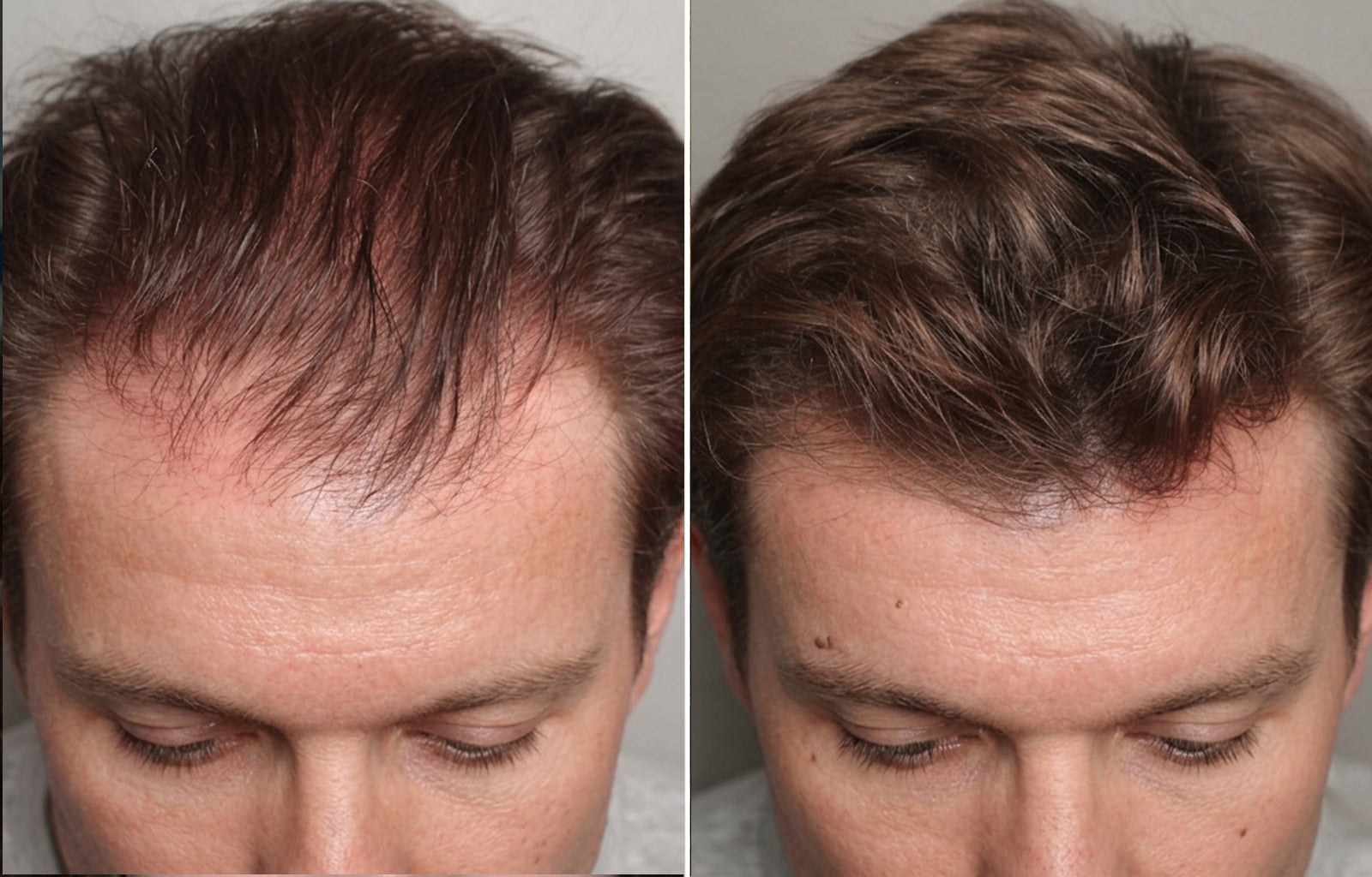 Before and after hair appearance for Michael, 39