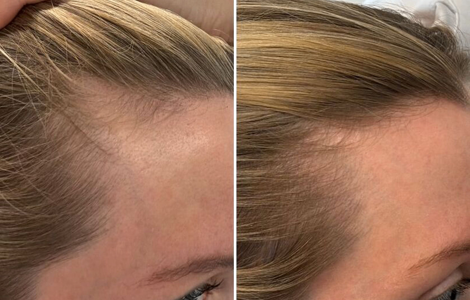 Before and after hair appearance for Hannah, 32
